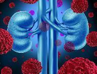 Clearing The Path: A Kidney Cancer Information Session