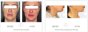 RF Microneedling Near Me for Skin: The Ultimate Guide to Skin Rejuvenation