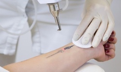 Three Tattoo-Removal Sessions on an Area Up to 5, 10, or 15 Square Inches at dr LASER (Up to 84% Off)