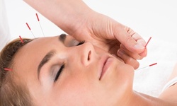 Two Acupuncture Sessions or One Acupuncture Session with Consultation at Choice Acupuncture (Up to 68% Off)