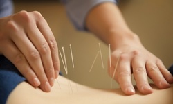 Up to 62% Off acupuncture package at Liberty Acupuncture & Wellness, P.C.