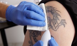 Three Tattoo-Removal Treatments for Up to 4, 8, or 12 Square Inches at Step Up Skin (Up to 87% Off)