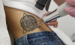 Three Laser Tattoo Removal Sessions at LaserAway(Up to 88% Off). Three Options Available.