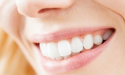 Up to 76% Off on Teeth Whitening - Traditional at kd beauty
