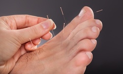 One or Three Acupuncture Sessions with Optional Cupping Session at Lifestyle Acupuncture (Up to 56% Off)