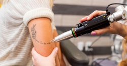 Laser Tattoo-Removal Treatments on Area of Up to 3 or 6 Square Inches at Couture Med Spa Oviedo (Up to 86% Off) 