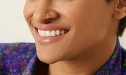 Up to 82% Off on Teeth Whitening - In-Office - Branded (Zoom, Brite Smile) at Skinnbody Spa Bar