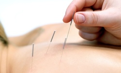 Two Acupuncture Treatments for pain at Complementary Health Care (Up to 80% Off)