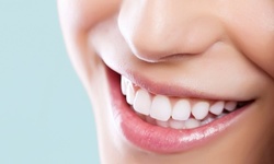 One, Two, or Three Teeth-Whitening Sessions at Body Beautiful Laser Medical Spa (Up to 76% Off)
