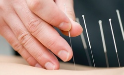 $62.80 for a 75-Minute Acupuncture Treatment and Medical Massage at Maple Acupuncture, LLC ($150 Value)