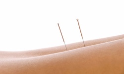 Two or Four Acupuncture Treatments with Exam and X-rays at Oliver Chiropractic and Acupuncture (92% Off)