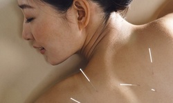 Acupuncture with Consultation at Acupuncture Family Practice (Up to 68% Off) 