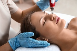One or Three Microneedling Treatments at DFW Laser Aesthetics (Up to 84% Off)