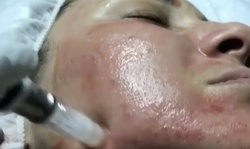 Up to 54% Off on Micro-Needling at Valspa Beauty & Aesthetics