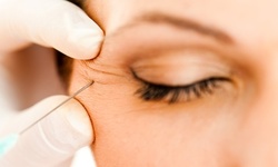 $179 for 20 Units of Botox at Revive Medical Spa ($240 Value)