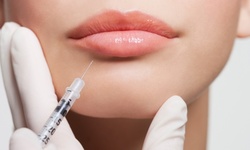 1 Syringe of Juvederm for Lip Enhancement, or 1 Syringe of Juvederm Ultra at Manhattan Laser Spa (Up to 65% Off)