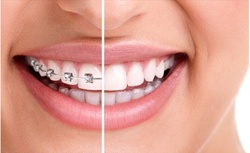 $29 for $2000 Off Braces or Invisalign Package at Tribeca Dental Studio ($2,350 Value)