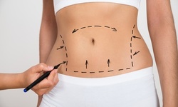 One or Three 60-Minute Cryolipolysis Sessions for a Chin or Body at Skin and Sculpt Aesthetics (Up to 60% Off)