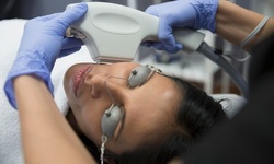 One or Two IPL Photofacials at Golden Health & Beauty Center (Up to 80% Off)