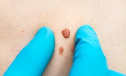 One Laser Mole or Wart Removal Treatment at Mobile Medical Clinic (Up to 36% Off)