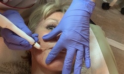 Plasma Fibroblast Treatment for One or Two Areas at Home Beauty Spa (Up to 52% Off)