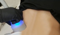 One, Two, or Three Cryolipolysis Treatments with CRYO T-Shock from Beautiful Laser Center LLC (Up to 48% Off) 