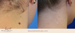 Up to 74% Off on Mole / Growth Removal at BeautyMarx Studio