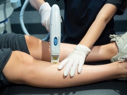 Two or Four Laser Spider Vein-Removal Sessions (Up to 66% Off)
