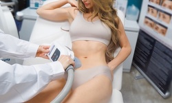 One CoolSculpting Treatment on One Small or Large Area at Eternal Med Spa (Up to 34% Off)