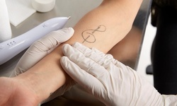 Three Laser Tattoo Removal Sessions at Rosenberg Plastic Surgery (Up to 89% Off). Three Options Available.