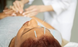 $36 for $150 Worth of Acupuncture — SPARK ACUPUNCTURE ASSOCIATES