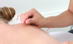 $51.85 for a Comprehensive Exam & Two Acupuncture Sessions ($215 Value) 