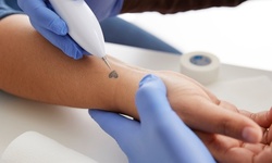 Three Tattoo Removal Sessions at Botanika Spa (Up to 75% Off). Three Options Available.