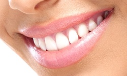 $134 for In-Office Teeth-Whitening Treatment at Town and Country Family Dentistry ($660 Value)