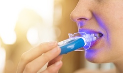 Teeth-Whitening Sessions at Skin Sational Spa. Choose from Five Options. (Up to 58% Off)