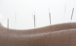 One or Two Acupuncture Treatments with Consultation at Dr. Doreen Morea (68% Off)