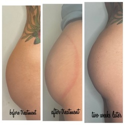 Up to 57% Off on Spa/Salon Beauty Treatments (Services) at Buttlift Babe