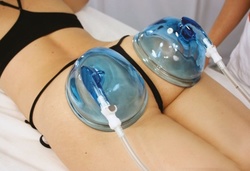 One or Two 30-Minute Vacuum Butt Lifts w/ Thermal Cellulite Treatment and More at Persona MedSpa (Up to 83% Off)
