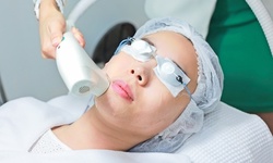 Laser Skin Resurfacing for Face or Neck, or Chest at Reddy Aesthetics (Up to 52% Off)