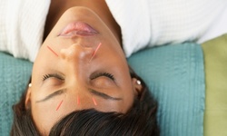 Acupuncture or Cupping at House of Health (Up to 52% Off). Six Options Available. 