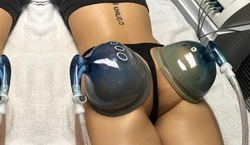 Up to 55% Off on Cupping at Florina's Beauty Center