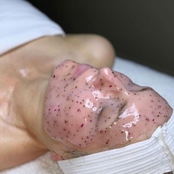 Up to 50% Off on Facial - Chemical Peel at AURAcle Aesthetics