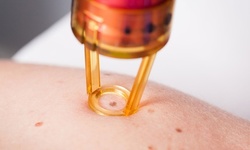 5 or 10 Small or 1 or 2 Medium, Skin Tag, Mole, Wart, Sun Spot, or Age Spot Removal at Linda Lin (Up to 50% Off)