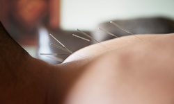 One Acupuncture Treatments with Conslutation at Phancore Wellness (Up to 49% Off)
