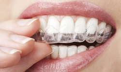 $30 for an Orthodontic Package with Whitening at American Braces & Smile Center ($3,200 Value)