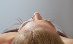 10- or 90-Minute Acupuncture Sessions at On Point Acupuncture & Wellness (Up to 51% Off)