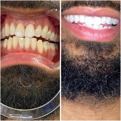 Up to 50% Off on Teeth Whitening - In-Office - Non-Branded at Charm’d Toothology
