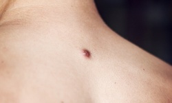 One Brown Spot, Wart, and Skin Tag Removal at Vitality (Up to 35% Off)