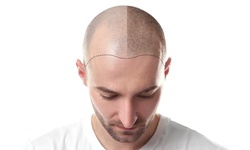 Hair-Stimulation Microneedling Sessions at Touch of Grace Luxury Day Spa (Up to 55% Off). Six Options Available.