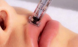 Hyaluronic Acid Lip Enhancement or Kabbeline at Casanova Beauty and Spa (Up to 50% Off). 5 Options Available.